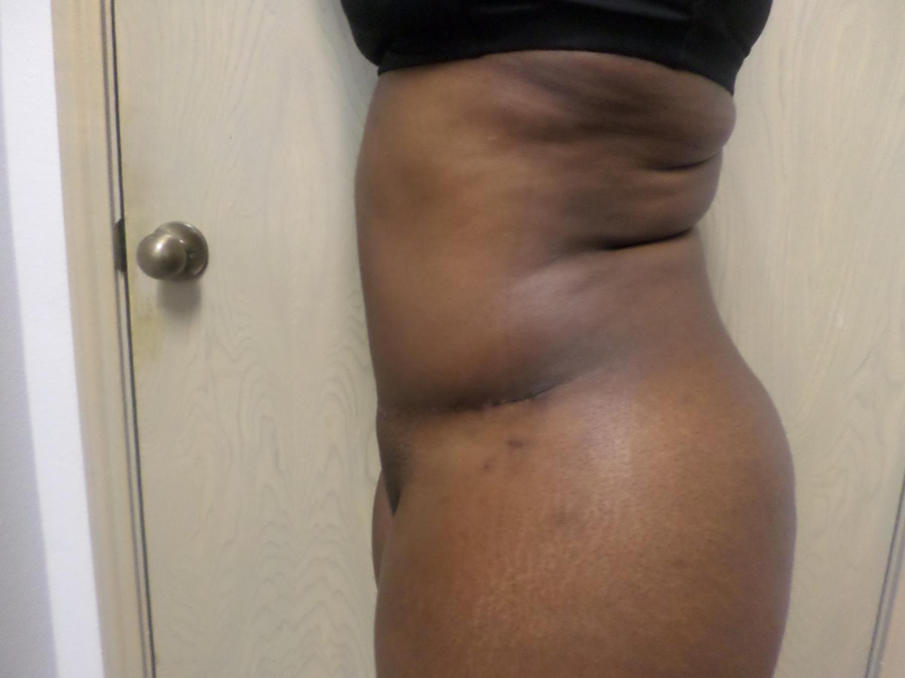 Liposuction: Patient 14 - After 3
