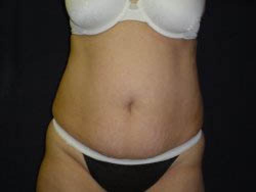 Liposuction - Patient 10 - Before