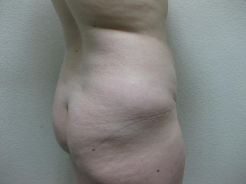 Liposuction - Patient 5 - Before 3