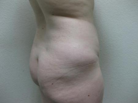 Liposuction - Patient 5 - Before Image 3