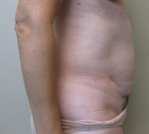 Tummy Tuck - Patient 6 - Before 5