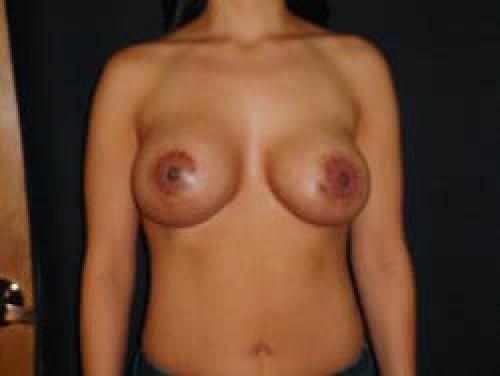 Breast Augmentation with Lift - Patient 4 - After 