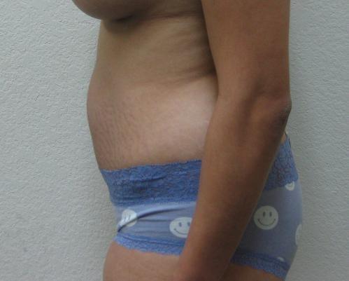 Tummy Tuck - Patient 12 -  After 3