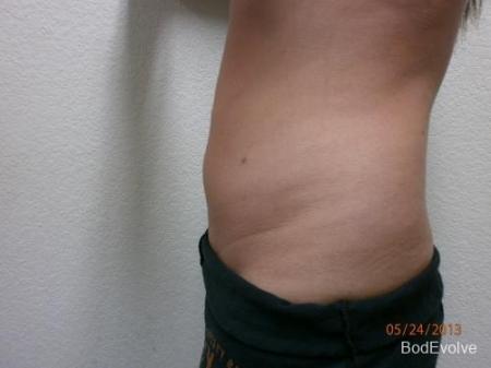Liposuction - Patient 2 - After Image 3