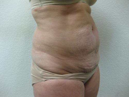 Tummy Tuck - Patient 4 - Before 5