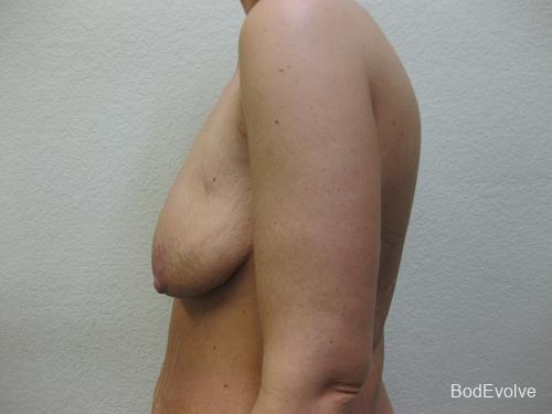 Breast Augmentation with Lift - Patient 1 - Before 3