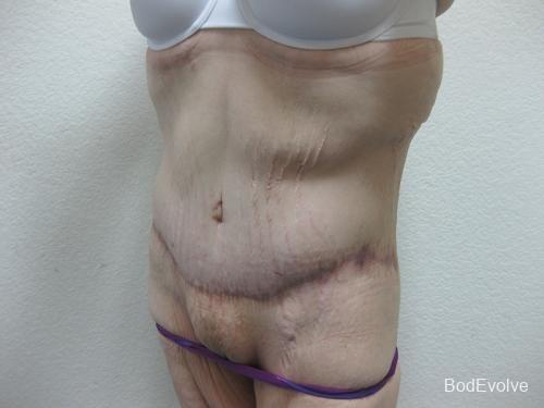 Patient 6 - Cosmetic Surgery After Massive Weight Loss -  After 3