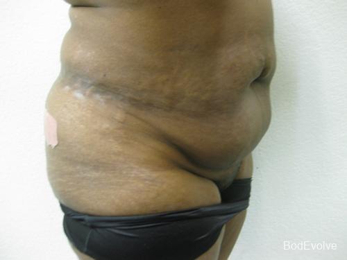 Tummy Tuck - Patient 1 - Before and After 5