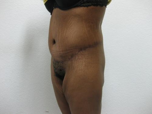 Body Lift - Patient 6 - After 3