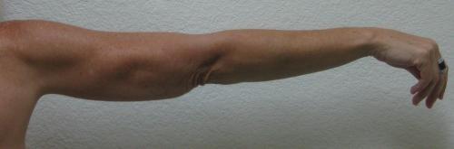 Arm Lift Surgery - Patient 3 -  After 4