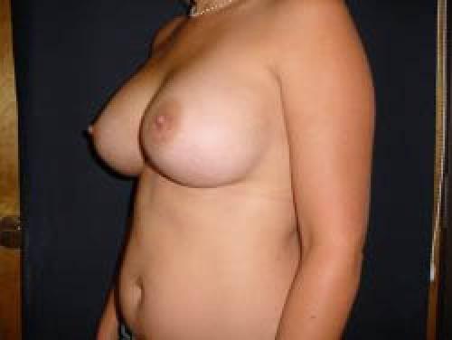 Breast Augmentation - Patient 19 -  After 2