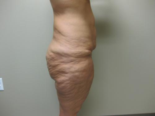 Patient 25 - Cosmetic Surgery After Massive Weight Loss - Before 7