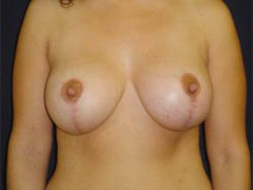 Breast Augmentation with Lift - Patient 3 -  After 1