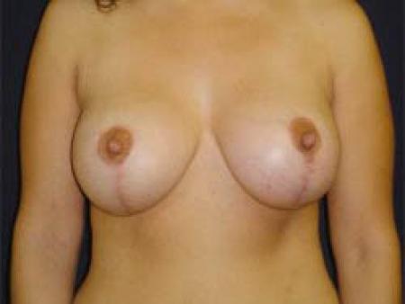 Breast Augmentation with Lift - Patient 3 - After 