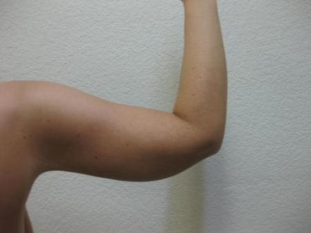 Arm Lift Surgery - Patient 1 - After Image 3