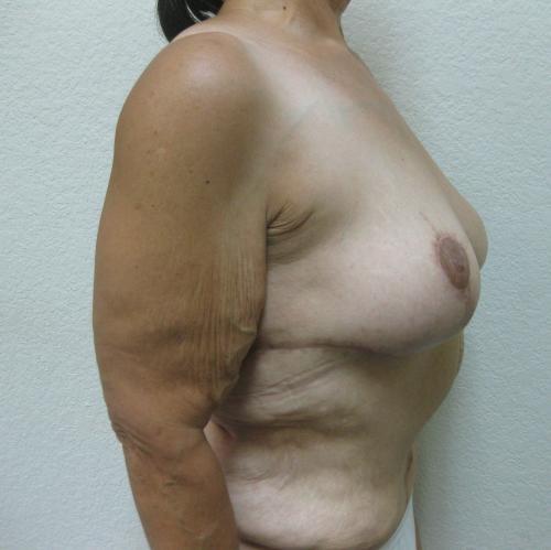 Patient 22 - Cosmetic Surgery After Massive Weight Loss -  After 5