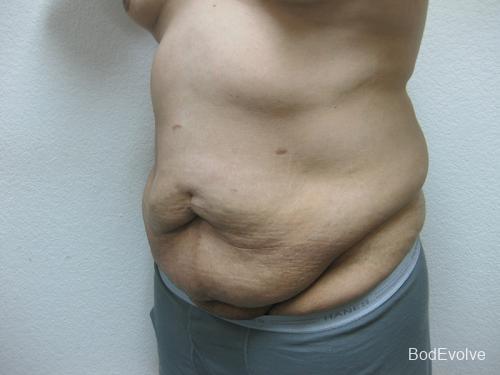 Body Lift - Patient 1 - Before 2