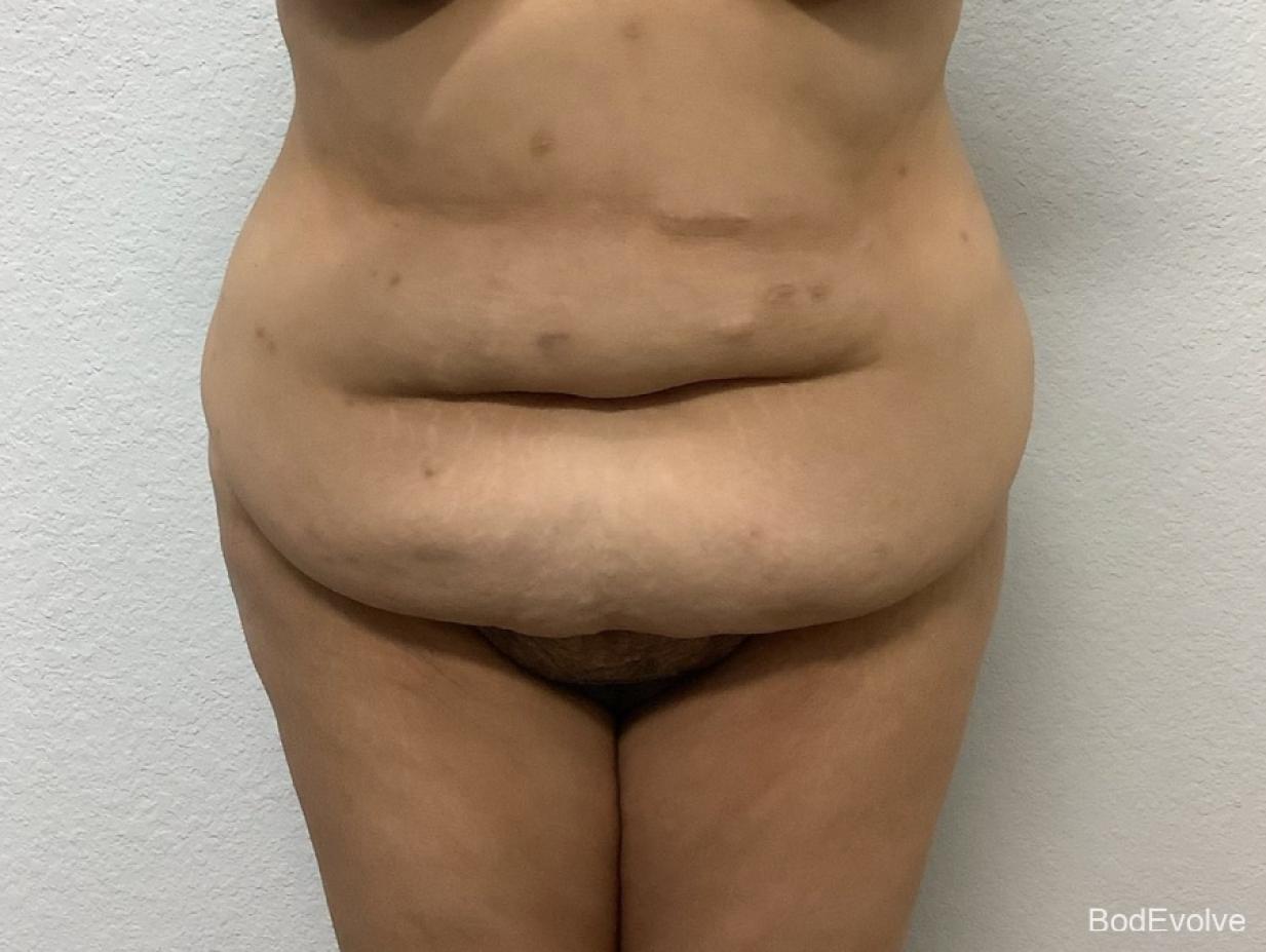 Tummy Tuck: Patient 2 - Before 