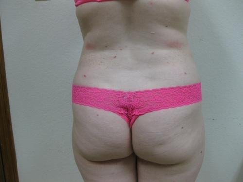 Liposuction - Patient 5 -  After 6