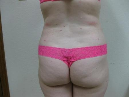Liposuction - Patient 5 - After Image 6