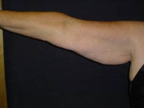Arm Lift Surgery - Patient 2 - Before and After 2