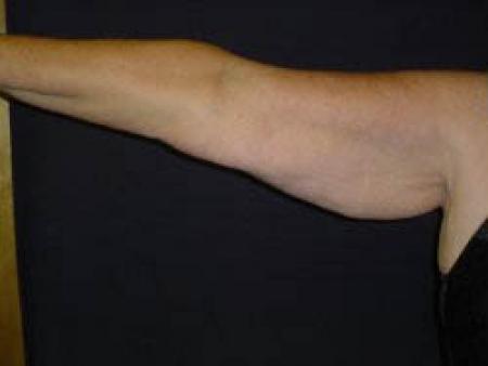 Arm Lift Surgery - Patient 2 - Before Image 2