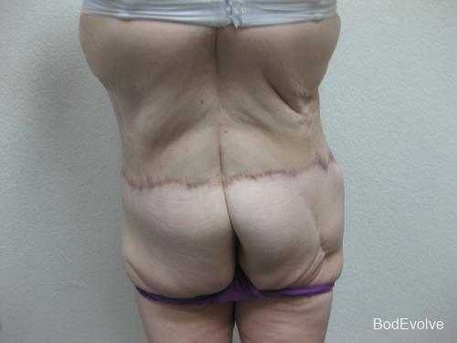 Patient 6 - Cosmetic Surgery After Massive Weight Loss -  After 6