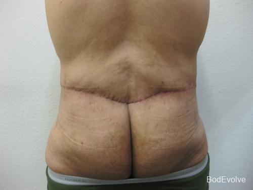 Patient 3 - Cosmetic Surgery After Massive Weight Loss -  After 5