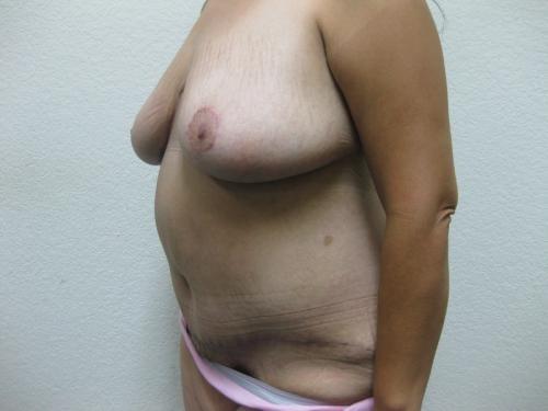 Patient 12 - Cosmetic Surgery After Massive Weight Loss -  After 2