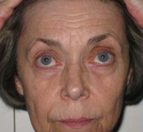 Laser Skin Resurfacing - Before 1