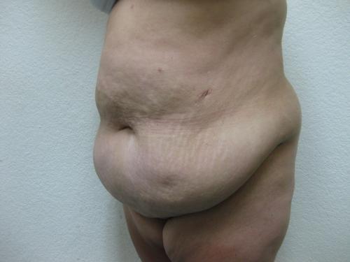 Patient 10 - Cosmetic Surgery After Massive Weight Loss - Before 2