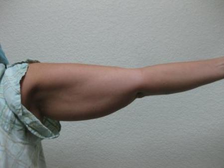 Liposuction - Patient 4 - Before Image 2