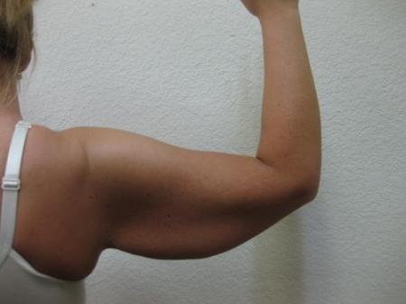 Arm Lift Surgery - Patient 1 - Before Image 3