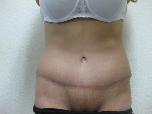 Patient 8 - Cosmetic Surgery After Massive Weight Loss -  After 2