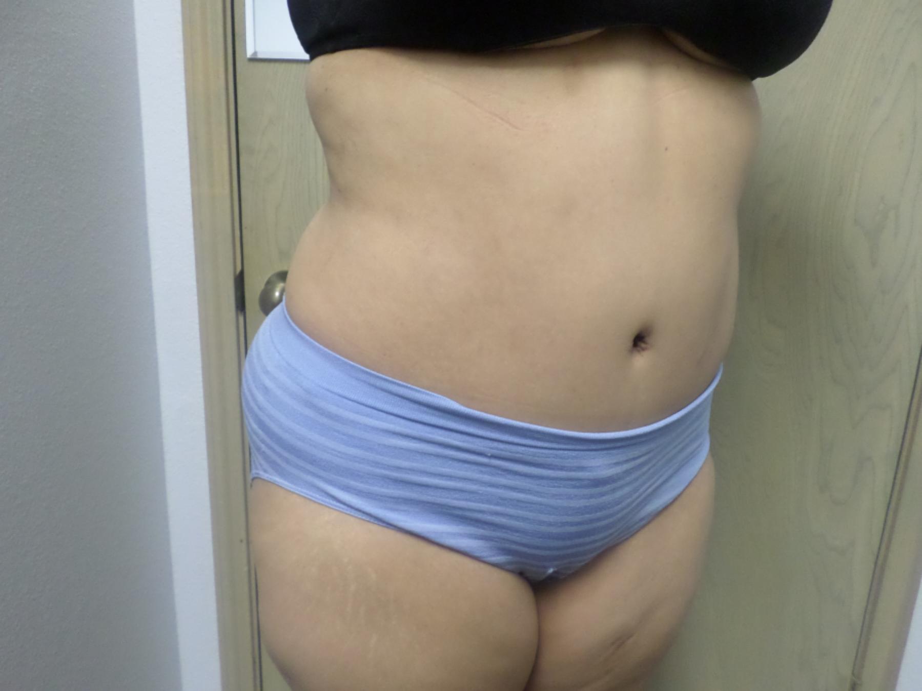 Liposuction: Patient 16 - After 4