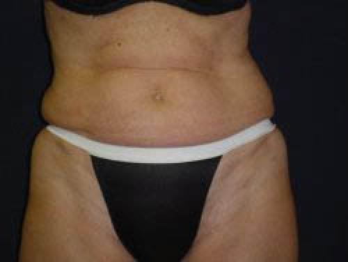 Tummy Tuck - Patient 8 - Before 1