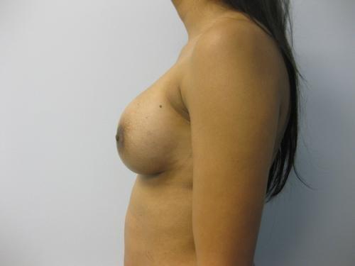 Breast Revision - Patient 2 -  After 3