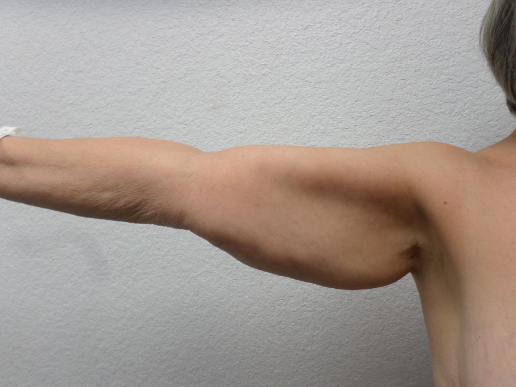 Arm Lift: Patient 9 - Before 4