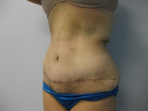 Patient 15 - Cosmetic Surgery After Massive Weight Loss -  After 2