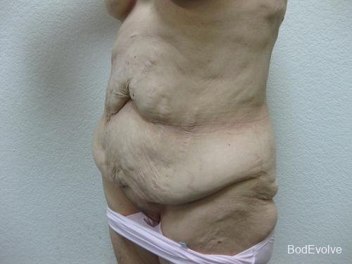 Patient 5 - Cosmetic Surgery After Massive Weight Loss - Before 2