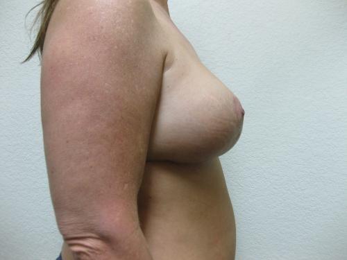Breast Reduction - Patient 3 -  After 3