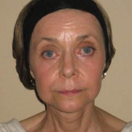 Facelift - Patient 2 - After Image 4