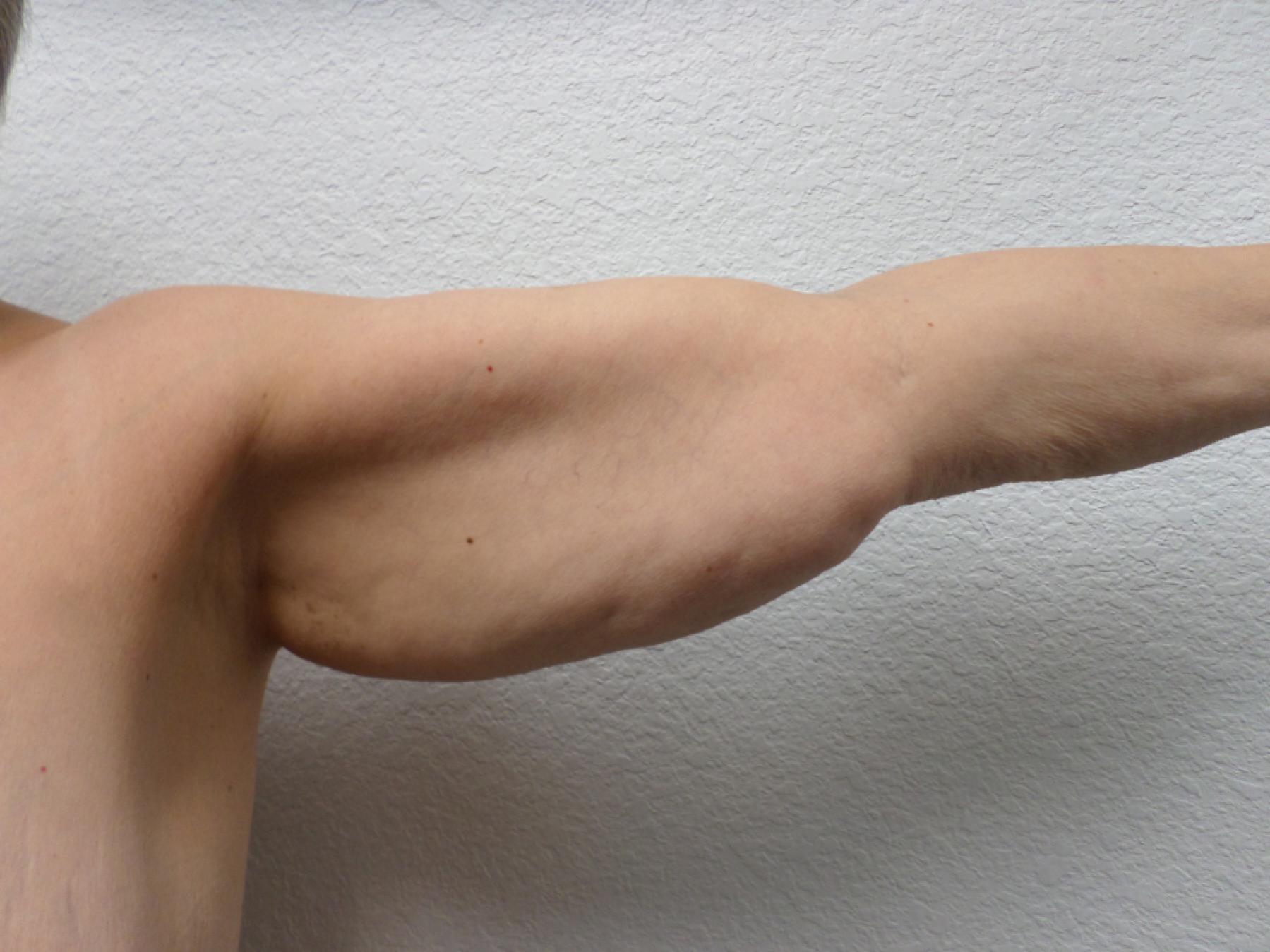 Arm Lift: Patient 9 - Before 2