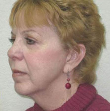 Facelift - Patient 1 - After Image 2