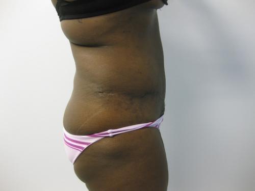 Patient 13 - Cosmetic Surgery After Massive Weight Loss -  After 5