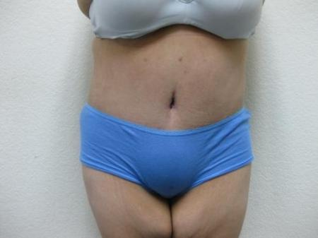 Patient 10 - Cosmetic Surgery After Massive Weight Loss - After 
