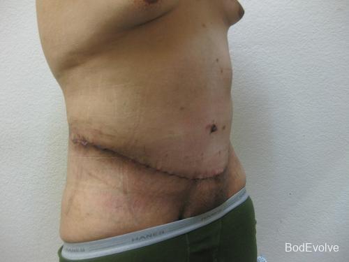 Patient 3 - Cosmetic Surgery After Massive Weight Loss -  After 8