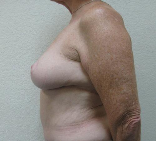 Breast Reduction - Patient 4 -  After 3