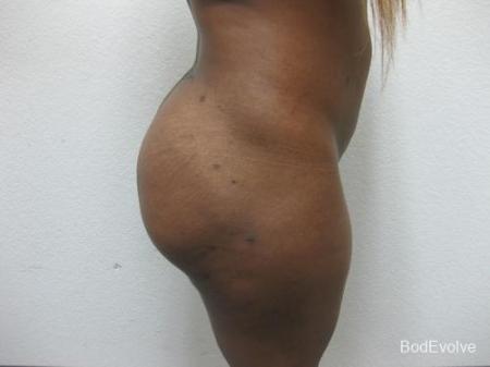 Brazilian Butt Lift - Patient 1 - After Image 3