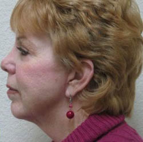 Facelift - Patient 1 - After 